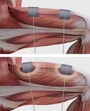 aidmoving rehamove como trabaja